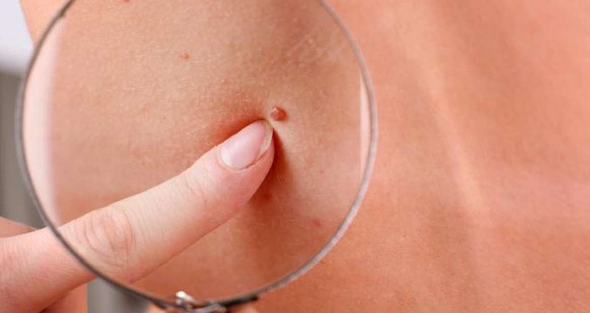 Análisis de lunares