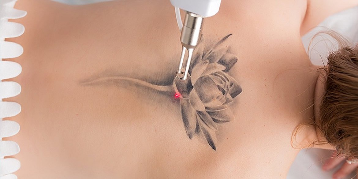 Retiro de tatuajes