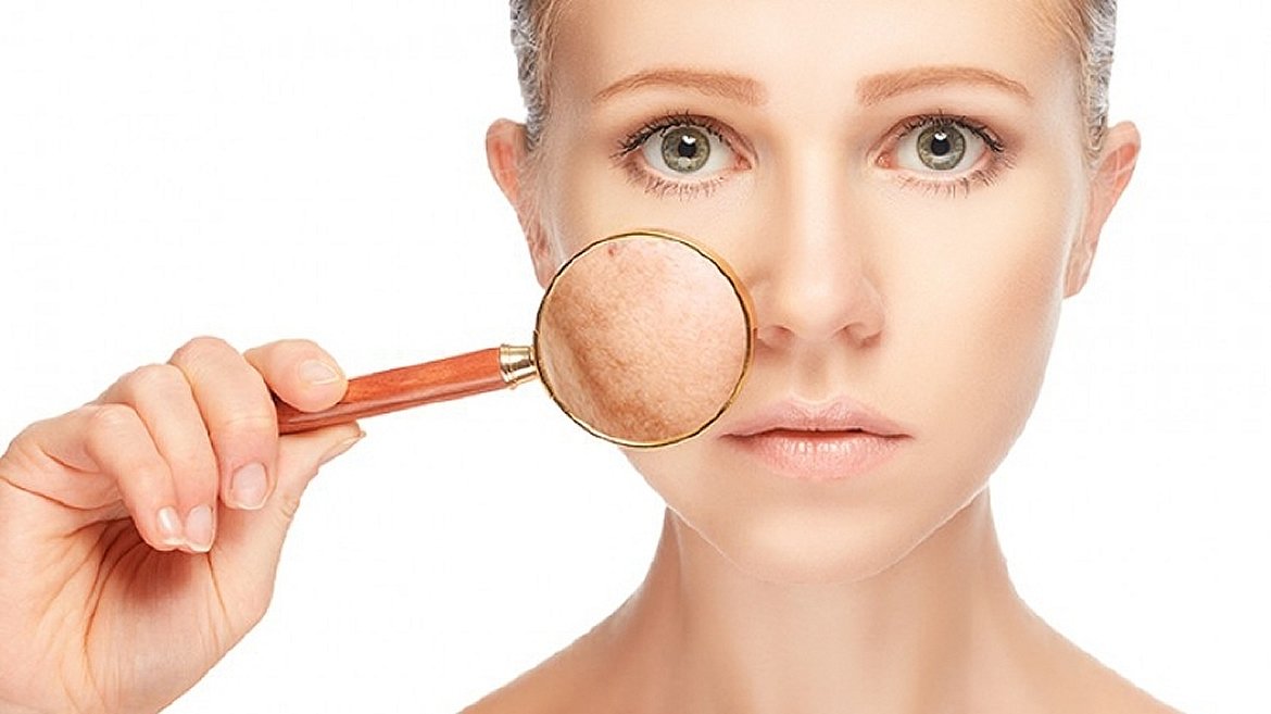 Tratamiento para melasma