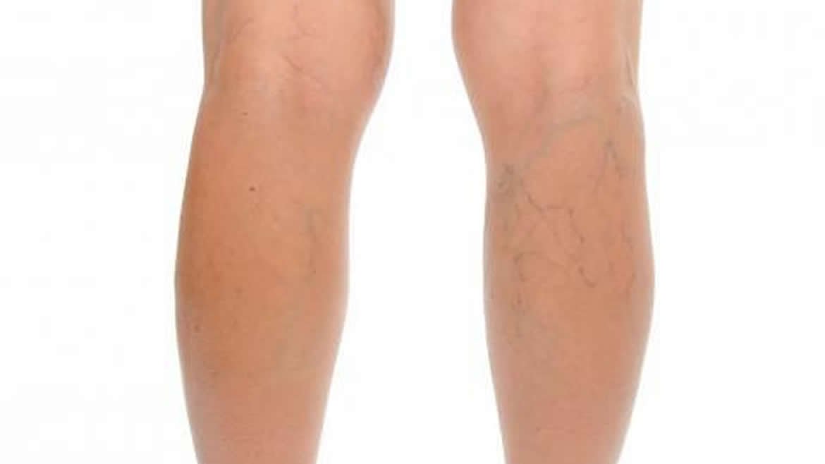 Tratamiento para varices