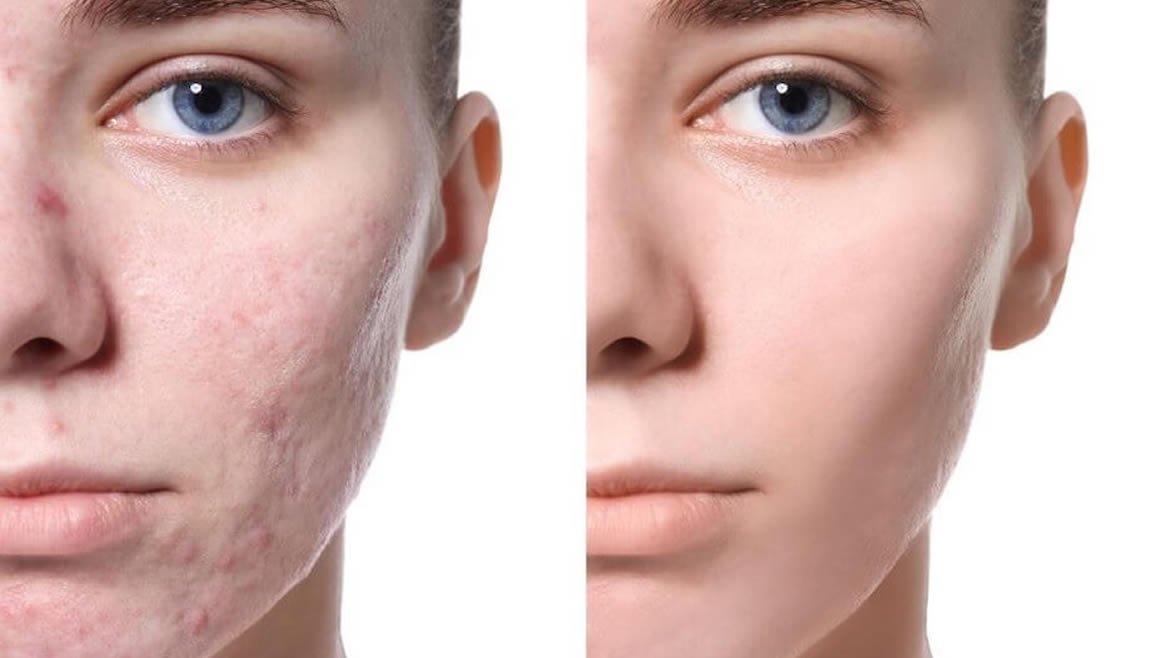 Tratamiento para acné y cicatrices