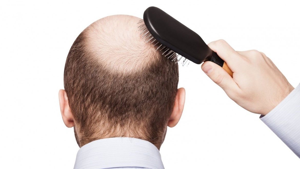 Tratamiento para alopecia