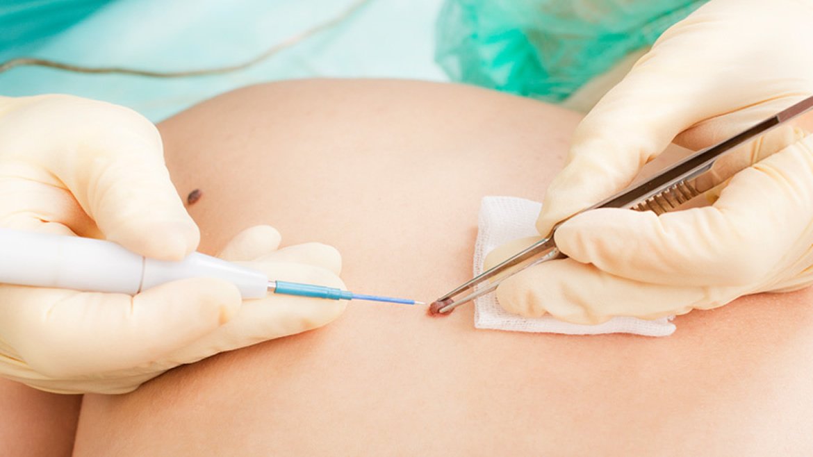 Cirugía dermatológica