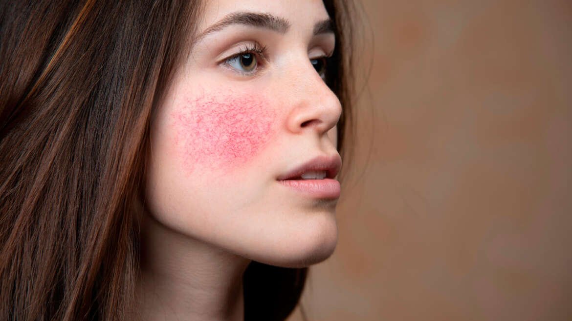 Tratamiento para rosácea