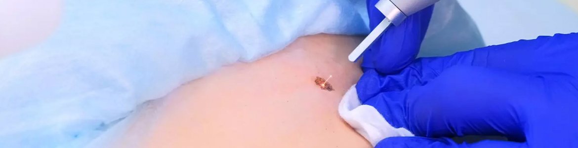 Lunares y cómo retirarlos
