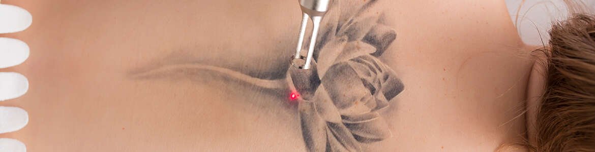 Todo sobre el retiro de tatuajes